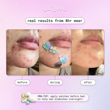 THE CREME- PINK AND HOLOGRAPHIC- ACNE PATCHES-(6PCS)